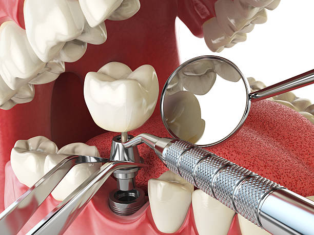 Best Emergency Root Canal Treatment in San Castle, FL